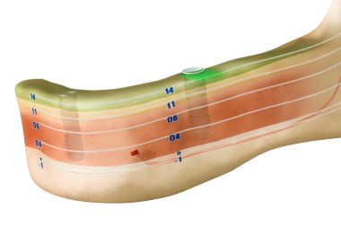 Kemiğin tepesinde diş implantı olan alt çene