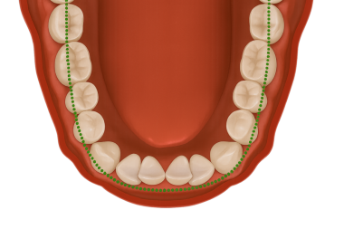 eğri büğrü ön dişleri ideal kavis ile