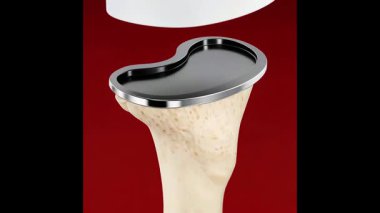 ortopedik cerrahi bacak ameliyatı tıbbi cgi animasyonu