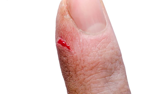 Răni Degetul Unui Bărbat Aproape — Fotografie, imagine de stoc