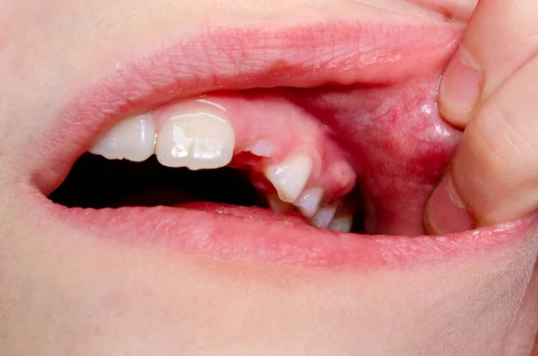 Choroba Gumy Próchnica Zębów Dziecka Obraz Stockowy