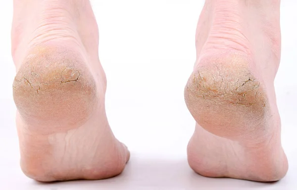 Yetişkin bir adamın topukları çatlamış. 