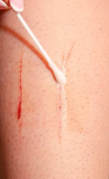 Applicare Antisettico Taglio Sulla Pelle Umana — Foto Stock