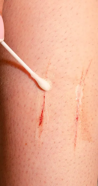 Applying an antiseptic to a cut on human skin with a cotton swab