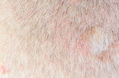 Yaşlanan kafa derisinin yakın çekim makro görüntüsü seyrek gri ve koyu renk saçlar ve görünür deri dokusu