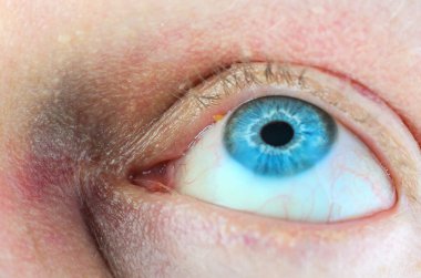 Göz kapağına yakın plan bir sivilce.