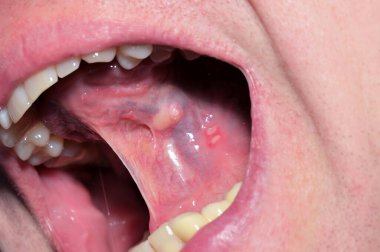 Bir insanın ağzının yakın görüntüsü iç yanak ve diş etlerinde birden fazla acı verici yara olduğunu gösteriyor.