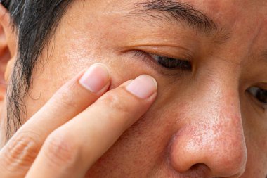 Göz tahrişinin, kuru göz sendromunun ya da alerjik konjonktivitin yakın çekimi. Göz kızarıklığı, görüş bakımı, göz hastalığı, göz sağlığı..