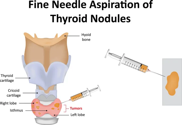 Thryoid 甲状腺の穿刺吸引 — ストックベクタ