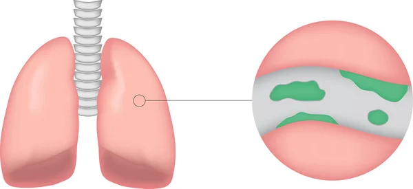 Diagrama de bronquiectasias sobre fondo blanco — Vector de stock