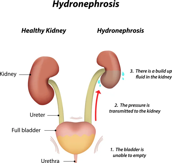 hidronephrosis prosztatitis