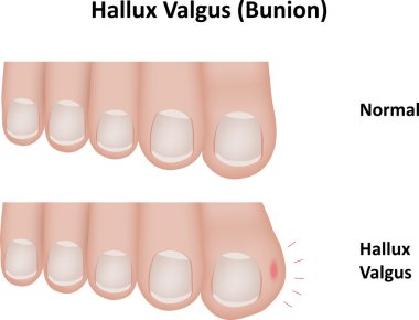 Hallux Valgus bunyon