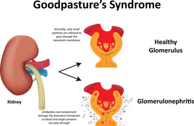 Goodpasture'nın Sendromu