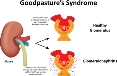 Goodpasture's Syndrome clipart