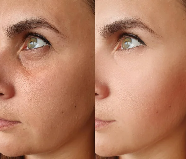 woman face wrinkles before and after treatment