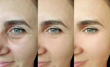 Kadın tedaviden önce ve sonra kırışıklıklarla karşılaşır