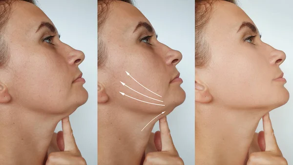 Woman Double Chin Treatment — Stock Photo, Image