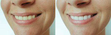 Kadın güzel gülümseme dişler önce ve sonra beyazlatma