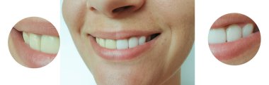 Kadın güzel gülümseme dişler önce ve sonra beyazlatma