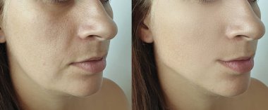 Kadın tedaviden önce ve sonra çift çene