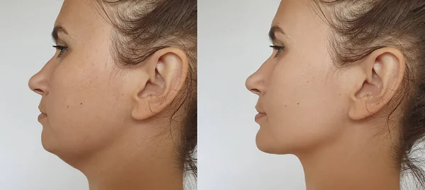 Doble Barbilla Mujeres Antes Después Del Tratamiento — Foto de Stock