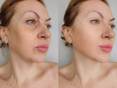 woman face wrinkles before and after treatment clipart