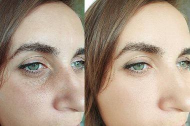 Kadın tedaviden önce ve sonra kırışıklıklarla karşılaşır