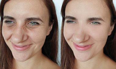 Kadın tedaviden önce ve sonra kırışıklıklarla karşılaşır