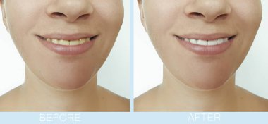 Kadın güzel gülümseme dişler önce ve sonra beyazlatma