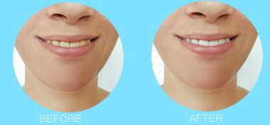 Kadın güzel gülümseme dişler önce ve sonra beyazlatma