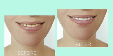 Kadın güzel gülümseme dişler önce ve sonra beyazlatma