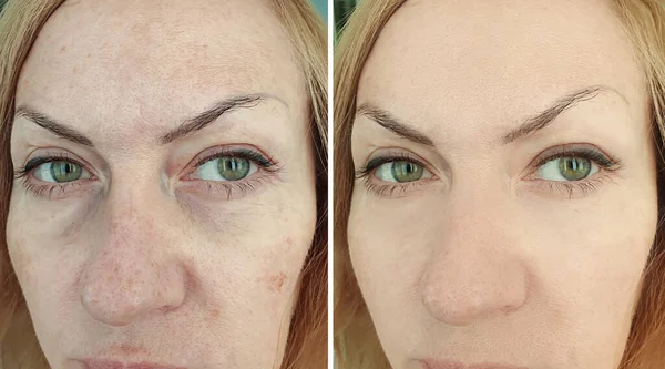 Kadın tedaviden önce ve sonra kırışıklıklarla karşılaşır