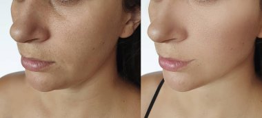 Kadın tedaviden önce ve sonra kırışıklıklarla karşılaşır