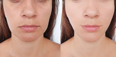 Kadın tedaviden önce ve sonra kırışıklıklarla karşılaşır