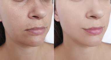 Kadın tedaviden önce ve sonra kırışıklıklarla karşılaşır