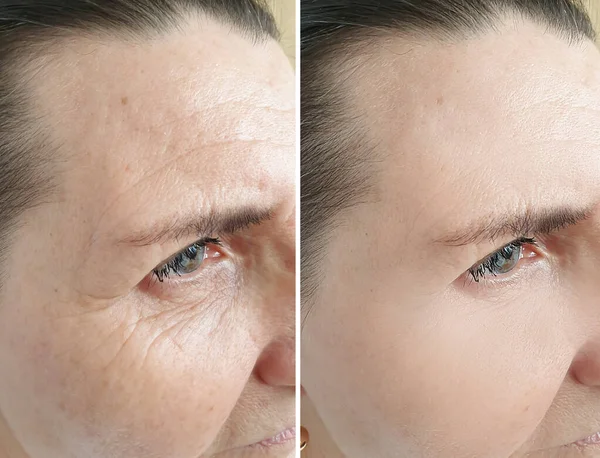 Woman Face Wrinkles Treatment — Stock Photo, Image