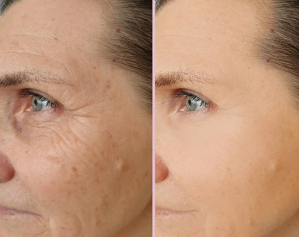 Falten Gesicht Der Frau Vor Und Nach Der Behandlung — Stockfoto