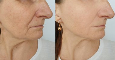 Kadın tedaviden önce ve sonra kırışıklıklarla karşılaşır