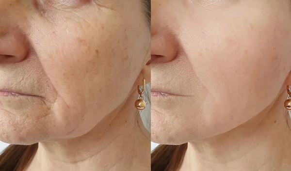 woman face wrinkles before and after treatment