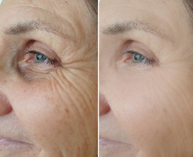 Kadın tedaviden önce ve sonra kırışıklıklarla karşılaşır