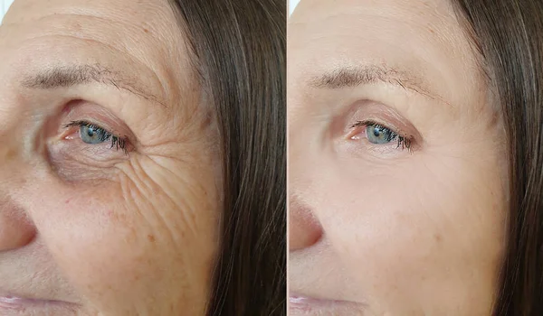 woman face wrinkles before and after treatment