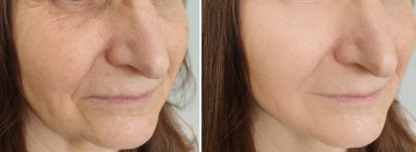 Kadın tedaviden önce ve sonra kırışıklıklarla karşılaşır