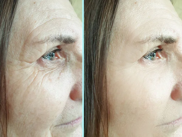 woman face wrinkles before and after treatment