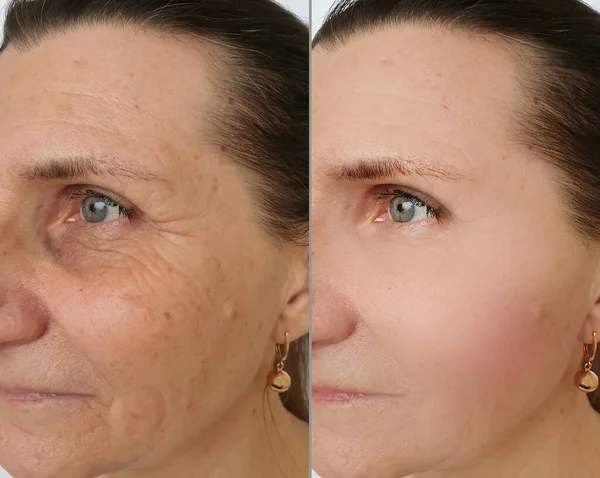 Woman Face Wrinkles Treatment — Stock Photo, Image