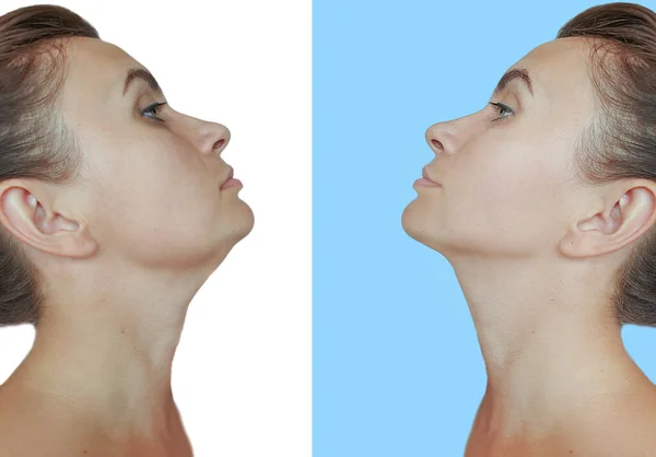 治療前と治療後の女性の二重あご — ストック写真