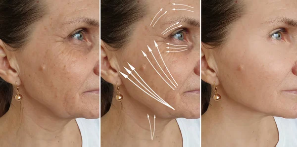 Woman Face Wrinkles Treatment — Stock Photo, Image