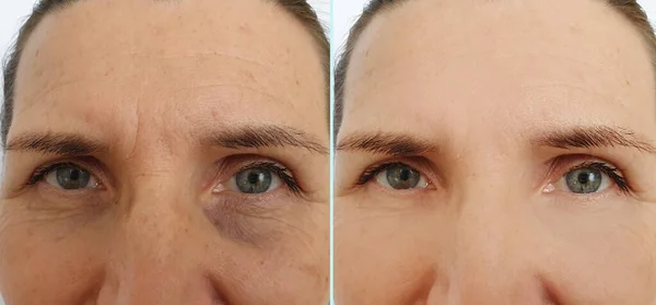 woman face wrinkles before and after treatment