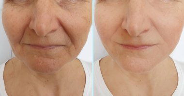 woman face wrinkles before and after treatment clipart