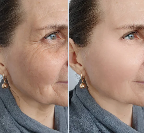 Woman Face Wrinkles Treatment — Stock Photo, Image