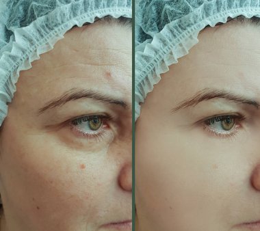 Kadın tedaviden önce ve sonra kırışıklıklarla karşılaşır